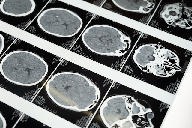 What is White Matter Disease, and How Is It Treated?