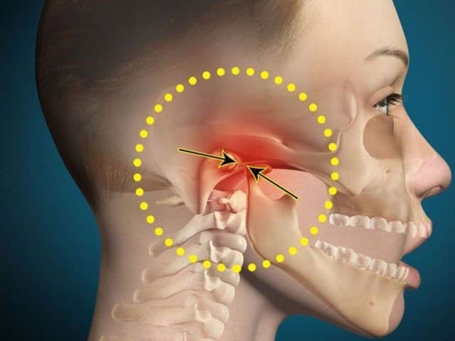 Understanding Locked Jaw: Causes, Symptoms, and Effective Remedies