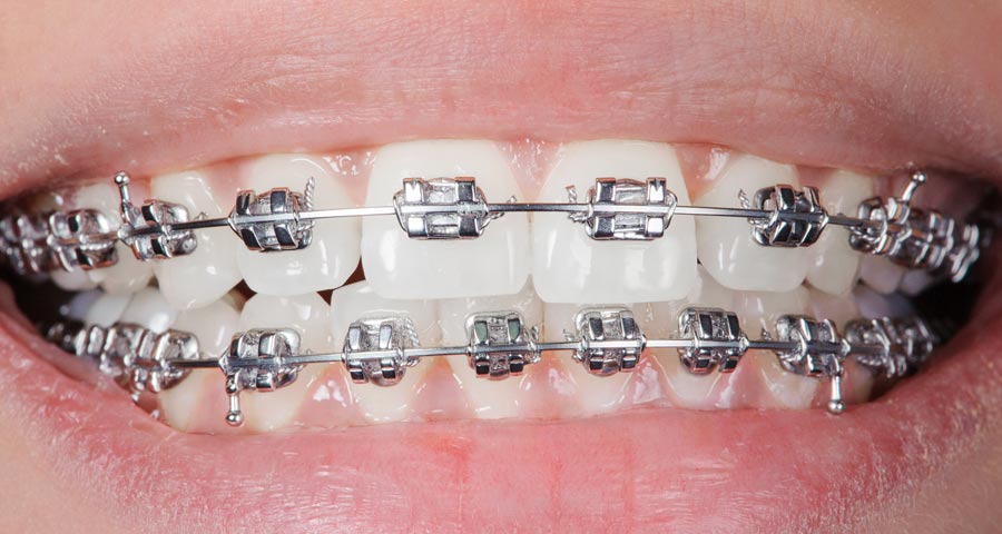 Braces and Tooth Extraction: When It’s Needed and What Patients Should Know
